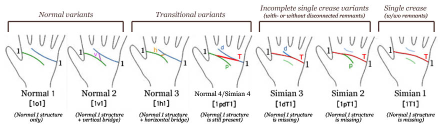 Simian line variants: single crease vs incomplete variants, transitional variants & normal variants!