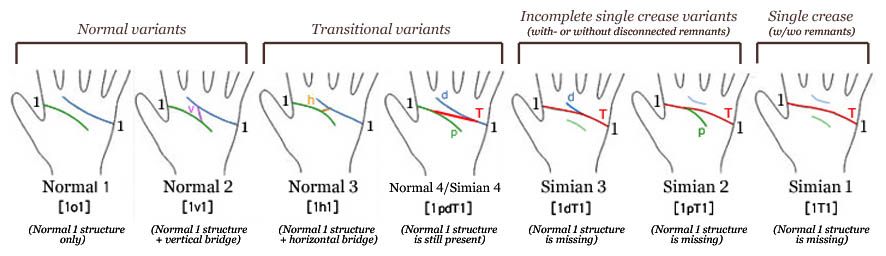 Palmar bilateral creases single Why Humans