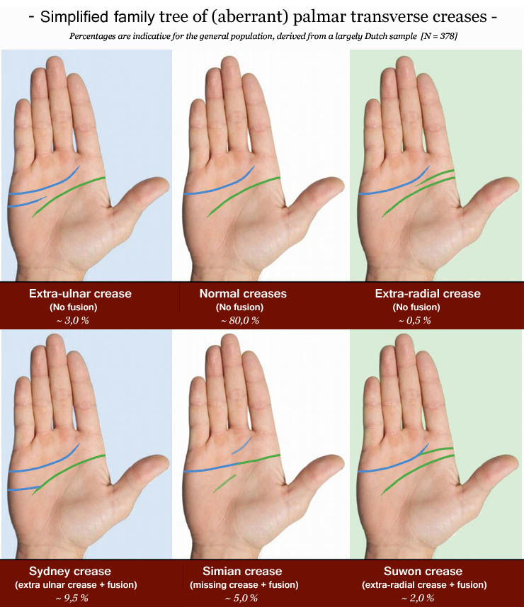 Simplified family tree of (aberrant) palmar transverse creases: Sydney crease, simian crease & Suwon crease.