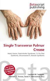 Single transverse palmar crease: research.