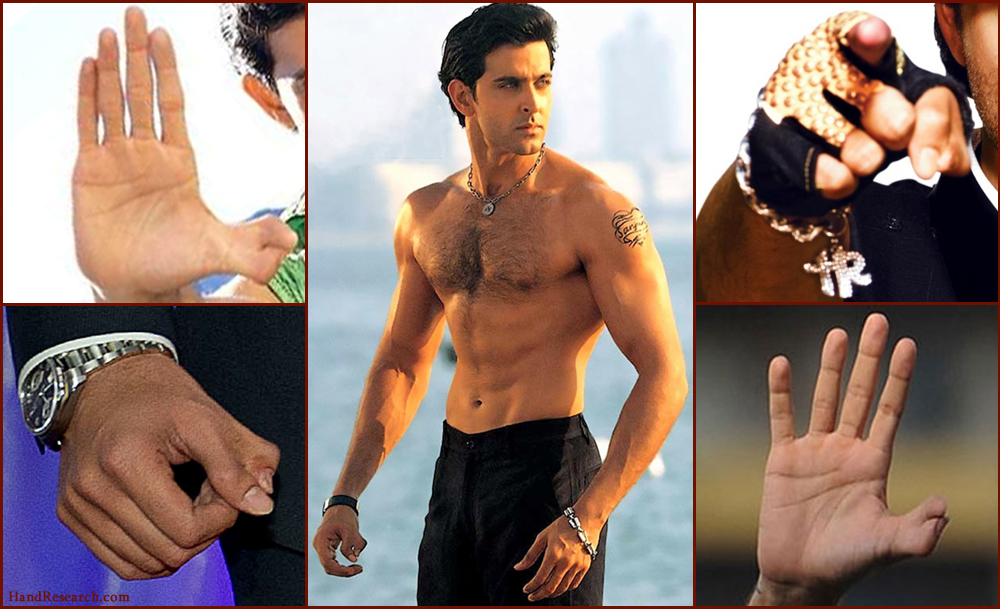 Hrithik Roshan thumbs: combination of polydactlyly + syndactyly.